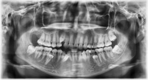 Health Consequences Of Abscessed Wisdom Tooth